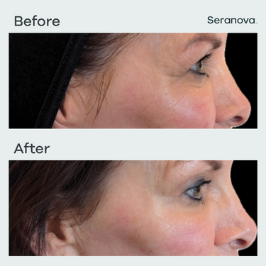 Seranova