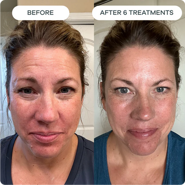 Fine Lines & Wrinkles