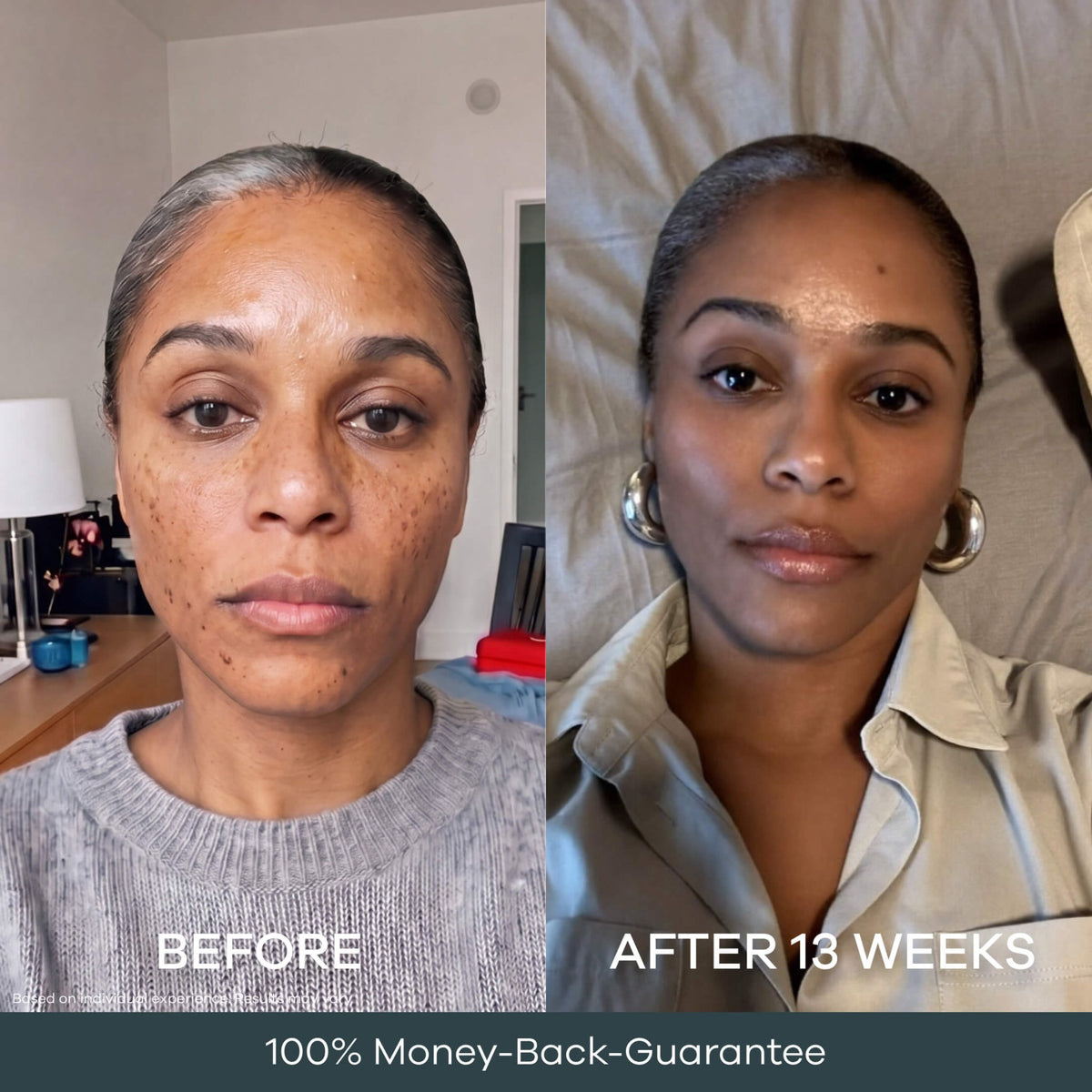 Uneven skin tone before and after 13 weeks of the Seranova pigmentation micro infusion system. Individual results may vary