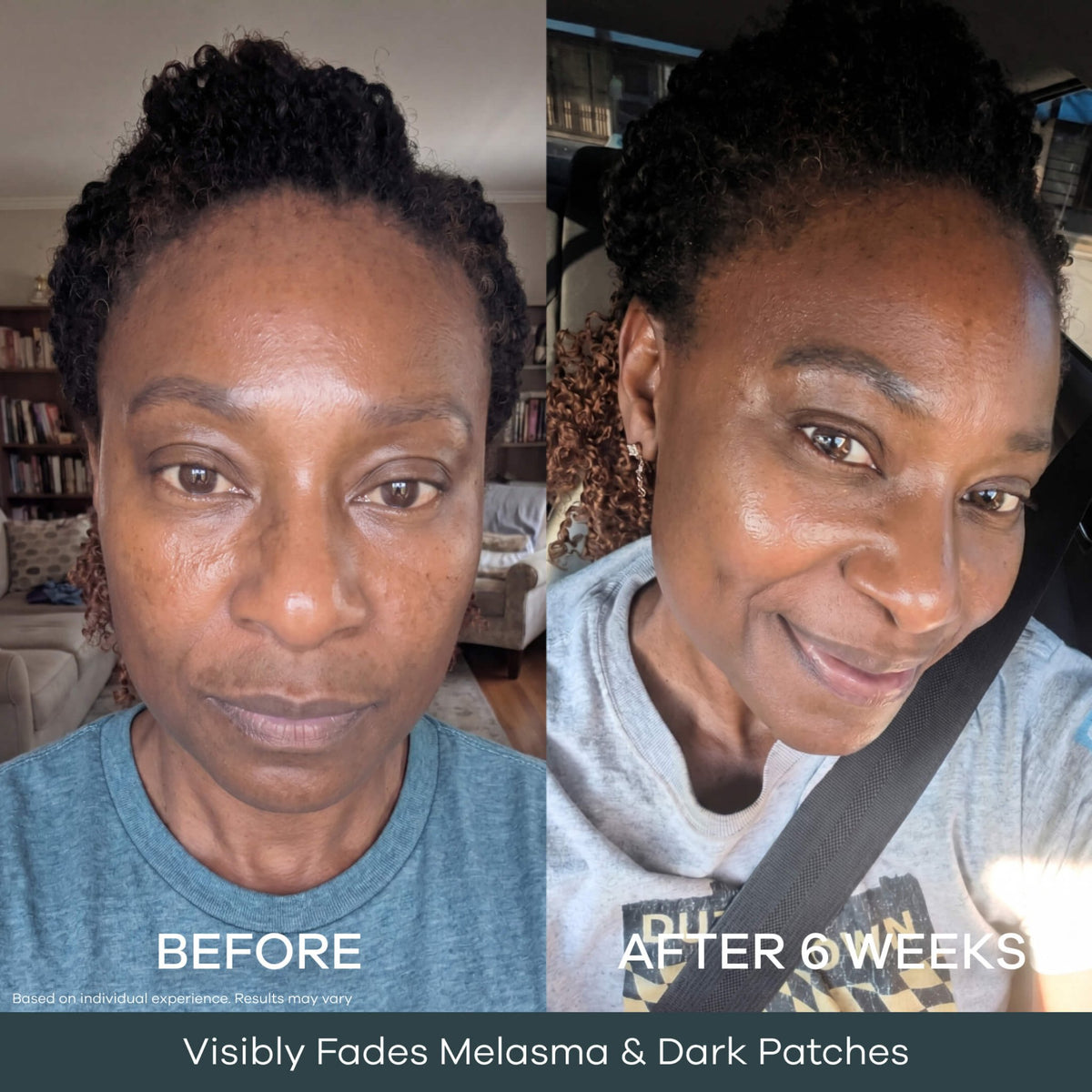 Dark patches visibly faded after 6 weeks of micro infusion application. Individual results may vary
