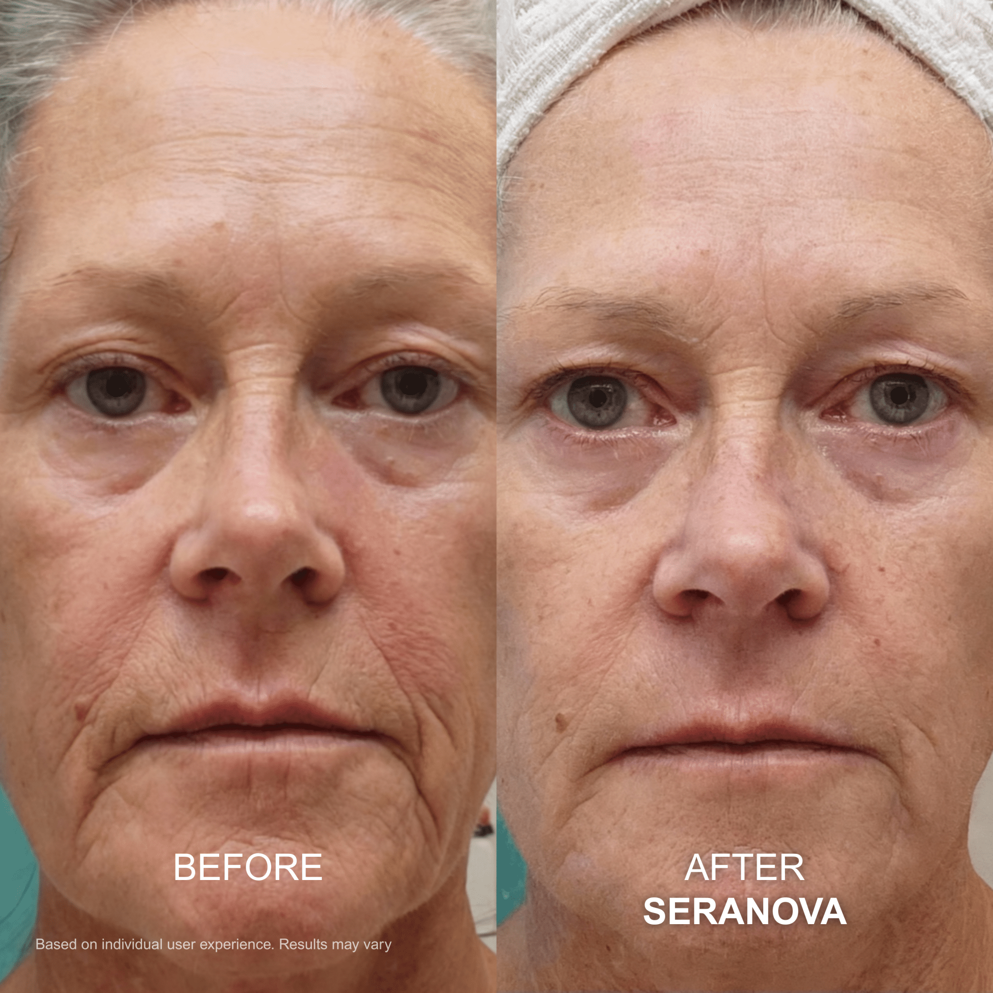 The Micro Infusion System™ - Seranova