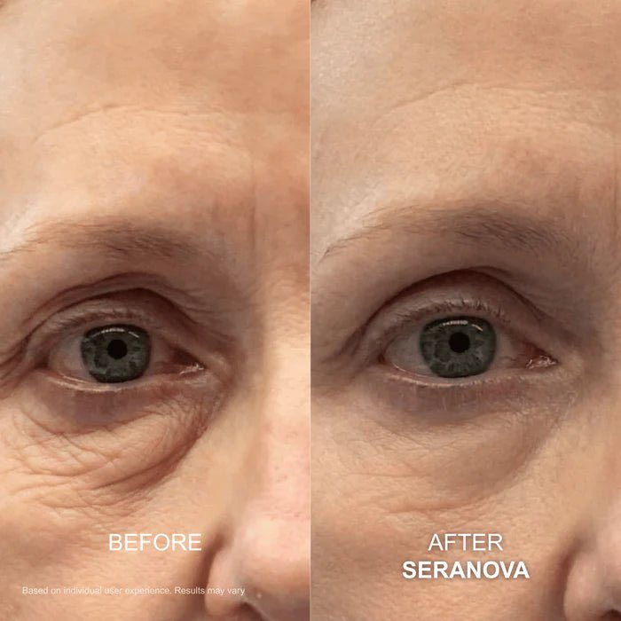 The Micro Infusion System™ - Seranova