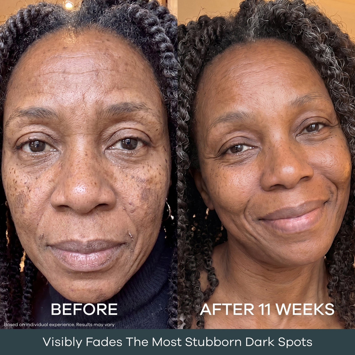 Dark spots before and after 11 weeks of at-home micro infusion application on melanin-rich skin. Individual results may vary