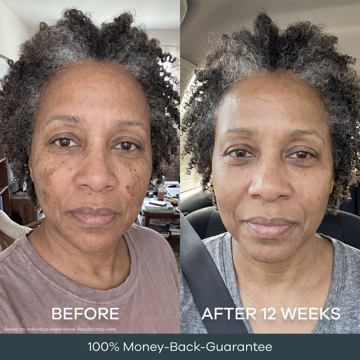 Age spots and dark patches on the cheeks before and after 12 weeks of at-home micro infusion. Individual results may vary