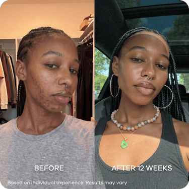 Dark Spots & Marks