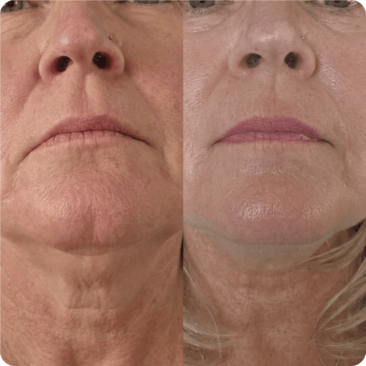Smoker lines customer transformation