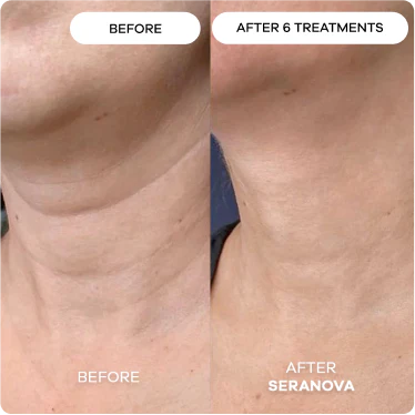 Wrinkly & Saggy Neck