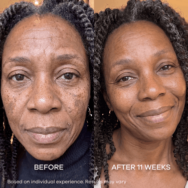 Dark Spots & Marks