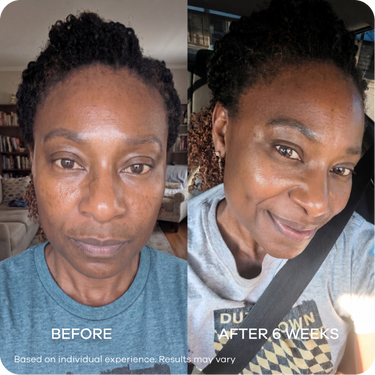 Melasma & Dark Patches