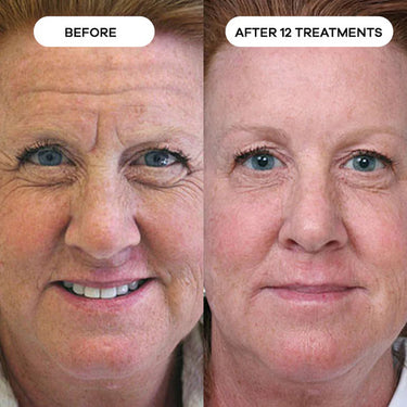 Forehead Wrinkles & Frown Lines