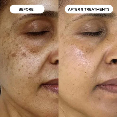 Dark Spots & Age Spots