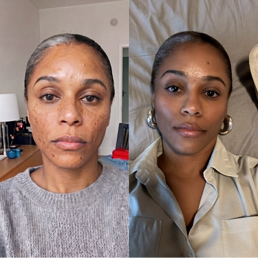 Dark Spots & Marks