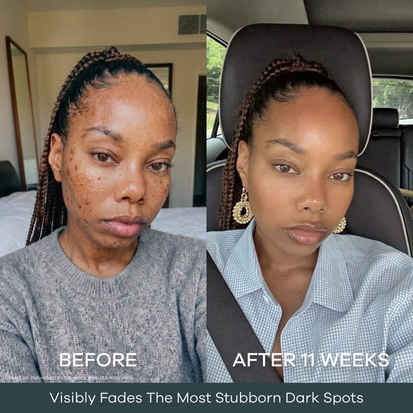 The Micro Infusion Pigmentation System™ - Seranova