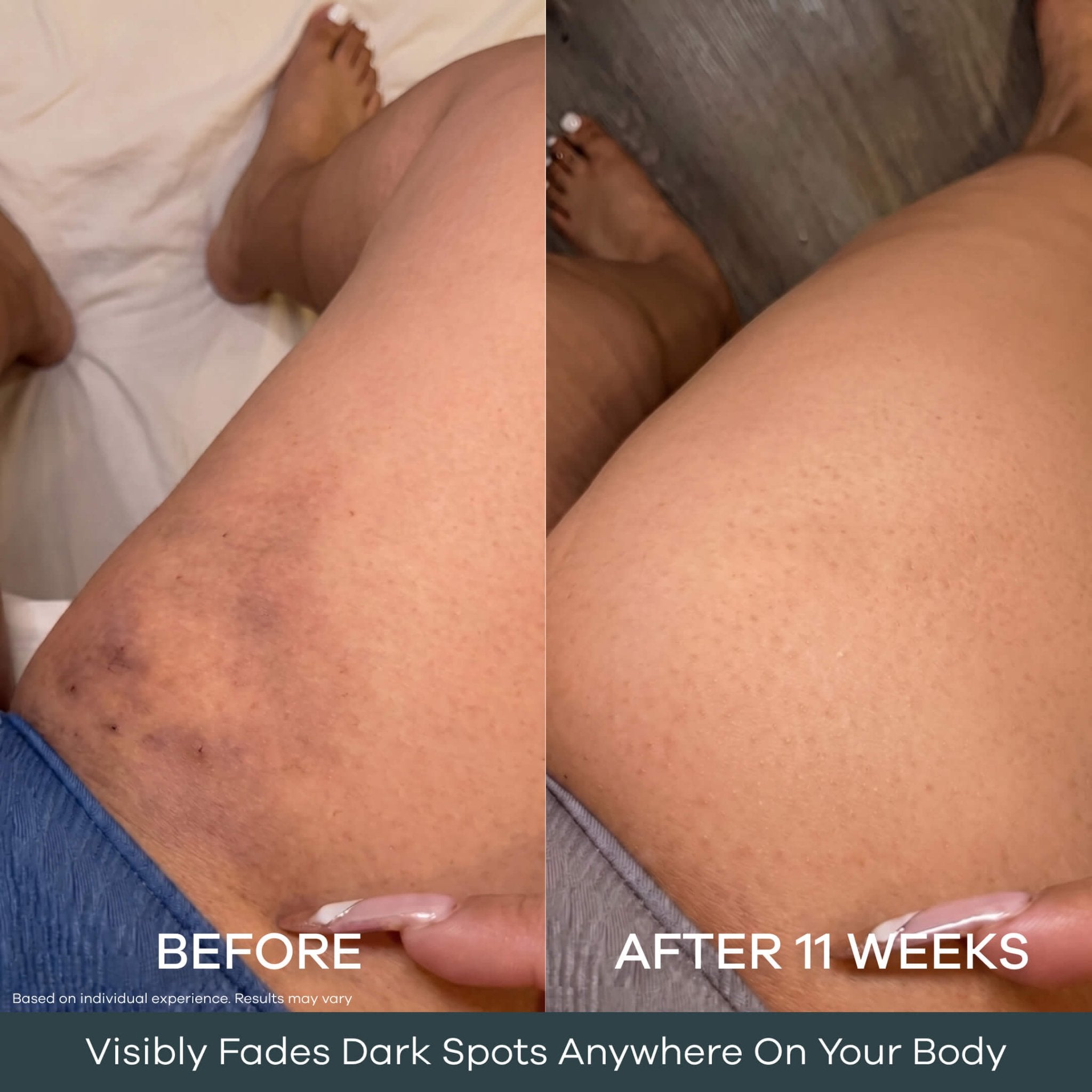 The Micro Infusion Pigmentation System™ - Seranova