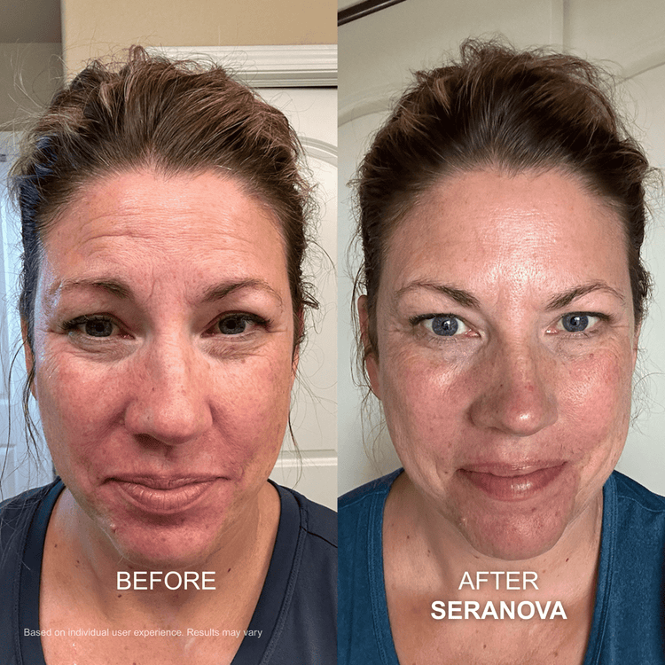 Forehead wrinkles customer transformation