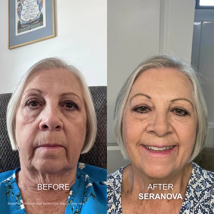 The Micro Infusion System™ - Seranova