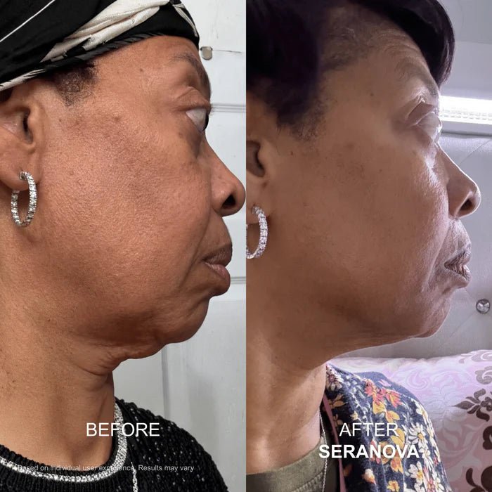 The Micro Infusion System™ - Seranova