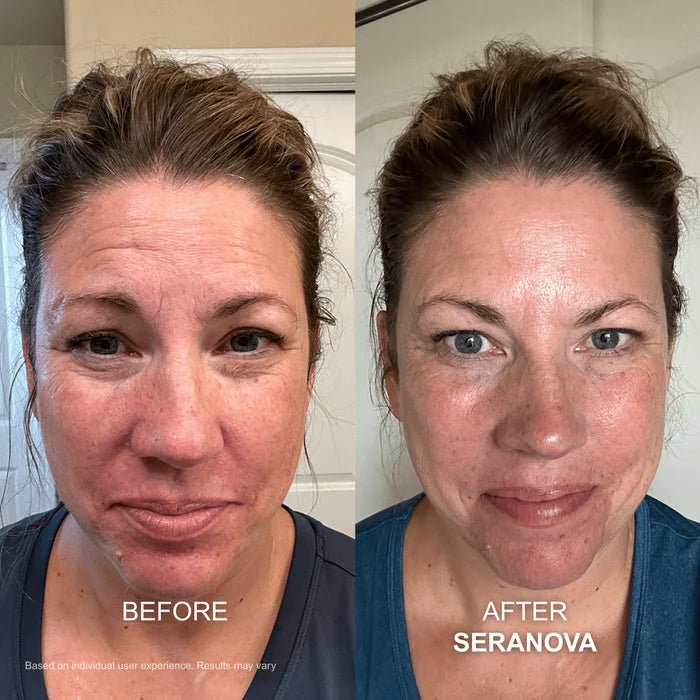 The Micro Infusion System™ - Seranova