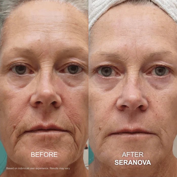 The Micro Infusion System™ - Seranova
